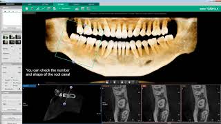 Clinical Case  Ez3Di  Endodontic Treatment C shaped Root Canal Case [upl. by Bisset]