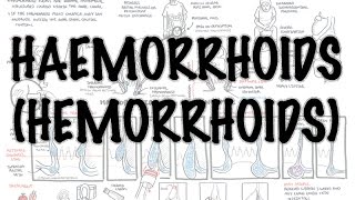 Haemorrhoids Hemorrhoids  Overview pathophysiology investigations and treatment [upl. by Ardnaiek]