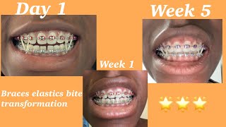 5 weeks of consistent braces elastics usage [upl. by Sivrat]