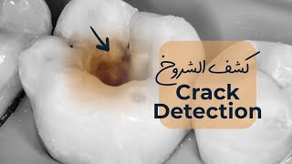 Case 9 I Crack Detection كشف الشروخ [upl. by Manvell58]