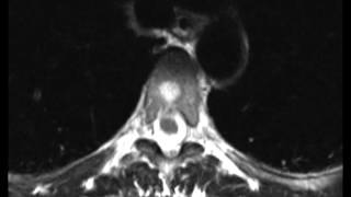 Typical and Atypical Hemangioma [upl. by Animahs]