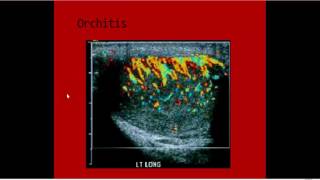 full story orchitisepidydmitisepidydmo orchitis imaging Dr Ahmed Esawy [upl. by Airtemad921]