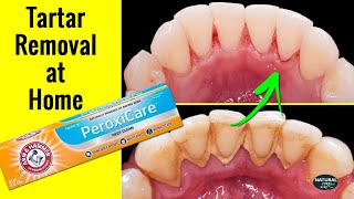 Best Toothpaste for Tartar Removal  Remove Tartar Buildup Fast Naturally  Dental Hygiene [upl. by Mccowyn]