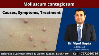 Molluscum contagiosum  Causes Symptoms Treatment [upl. by Atenik]