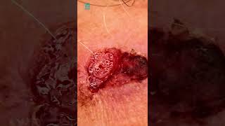 What is squamous cell carcinoma  Shorts [upl. by Eimas]