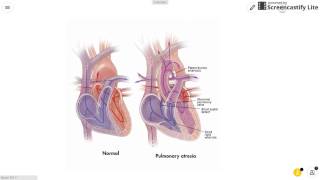 Pulmonary Atresia [upl. by Noda]