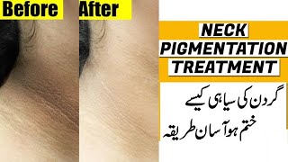 Dark Neck Removal l How to Get Rid Of Dark Neck At Home In Just 20min Get CLEAR White Neck [upl. by Lower]