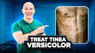 How to Treat Tinea Versicolor and Keep it From Coming Back  🛑 SEE MY PINNNED COMMENT FOR UPDATE👇 [upl. by Nahpos]