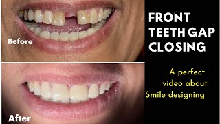 Front teeth gaping treatment with Zirconia Crowns  solution for space between front teeth [upl. by Feldt]