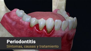 Provenza Clínica Dental  Periodontitis Síntomas Causas y Tratamiento [upl. by Grew]