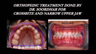 NonExtraction Braces amp Functional Jaw Orthopedics FJOALFPalatal ExpanderFacemaskBioblock [upl. by Lonna]