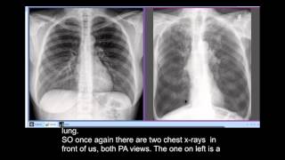 Chest xrays  Smokers Disease COPD  unusual radiographic feature Sabre Sheath Trachea [upl. by Filmore]