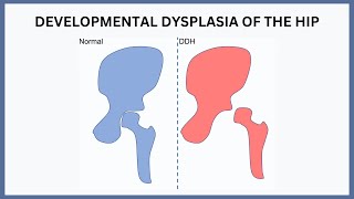 Developmental Dysplasia of the Hip Explained [upl. by Winsor992]