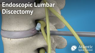 Endoscopic Lumbar Discectomy [upl. by Nairb906]