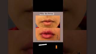 Filler lips 0530550870 kenitra morocco 0628862910 rabat filler 0628862910 casablanca [upl. by Colby734]