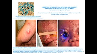 HUMAN M pox Monkeypox Infection And Morbidity Persist Since The Recent Global Outbreak [upl. by Freberg]