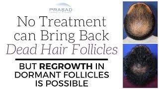 Why No Treatment can Revive Dead Hair Follicles but Regrowth of Dormant Follicles is Possible [upl. by Arayc]