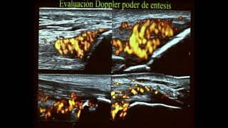 ECOGRAFIA DOPPLER MUSCULO ESQUELETICO Y ARTICULAR [upl. by Pena]