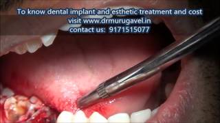 immediate extraction and implant placement in india [upl. by Nehtiek]