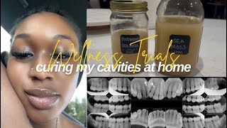 the truth about cavities and how to get rid of them at home [upl. by Naot]