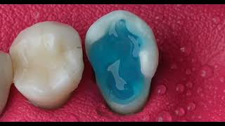 Restoration of Tooth  Root Canal Treatment and Dental Bridge Process dentist video [upl. by Cartan]