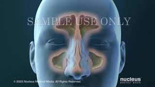 Sinusitis Surgery [upl. by Attolrahc]