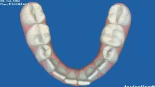 Invisalign Express OrthodonticsBefore amp AfterMick Family Dental [upl. by Naenej386]