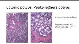 GI polyps GIPATH [upl. by Nylodnarb]