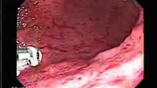 Video Endoscopy of Severe gastritis [upl. by Galina]