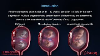 UOG video abstract Outcome of twin pregnancy with two live fetuses at 11–13 weeks’ gestation [upl. by Salokkin]