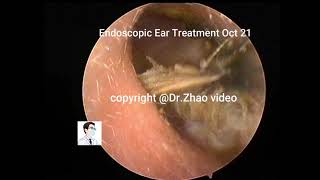 Reexamination of cholesteatoma [upl. by Ratha]