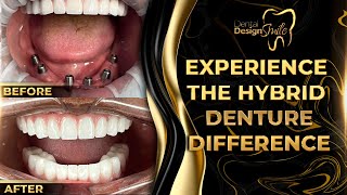 Experience the Hybrid Denture Difference [upl. by Rourke]