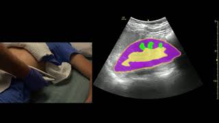 Kidney Ultrasound Scanning Technique [upl. by Cullan]