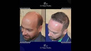 GREAT HAIR TRANSPLANT RESULT BY NORWOOD 7  Dr Pittella [upl. by Spencer673]