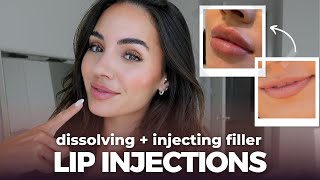 LIP INJECTIONS Dissolving and reinjecting lip filler process  all you need to know [upl. by Mcclure]