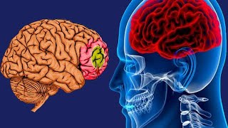 Brain Hypoxia Causes And Symptoms [upl. by Raina]