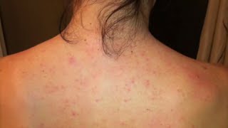 Dayna’s Story Improvement with Folliculitis or “Back Acne” [upl. by Alameda400]