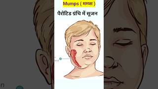 mumps  गलसुआ   mumps in hindi  mujpe symptoms shorts reels [upl. by Bee]