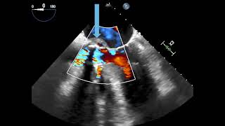 Prosthetic Aortic Valve Dehiscence with Paravalvular Leak blue arrow [upl. by Leugim385]