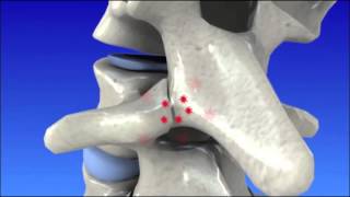 Degenerative Disc Disease  Spine Degeneration [upl. by Mundford463]