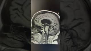 Hidrocefalia de pressão normal e seu diagnóstico na ressonância magnética de crânio [upl. by Afnin]