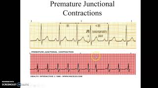 Junctional Rhythms and Premature Junctional Contractions [upl. by Gowrie]