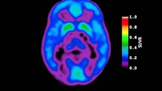 Video of AmyloidBeta Deposition in Autosomal Dominant Alzheimers Disease [upl. by Aro]