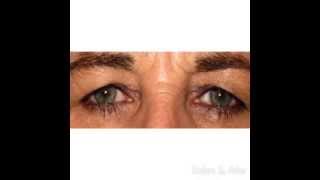 Ptosis Repair with a Levator Advancement in Tampa FL [upl. by Muriah426]