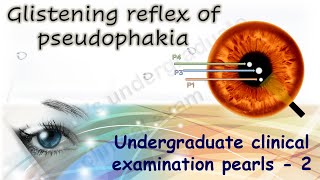 Glistening reflex in pseudophakia Undergraduate Clinical Examination Pearls 2 [upl. by Asyral38]