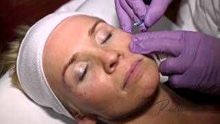 Dr Berne Harmony Program Oslo Azzalure Botox Restylane Tear Trough [upl. by Namya]