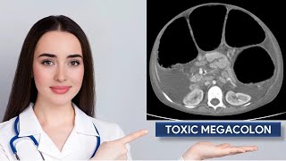 Toxic Megacolon  Megacolon Toxicum  Toxic Colitis  Xray Abdomen  CT Abdomen [upl. by Ataynek]