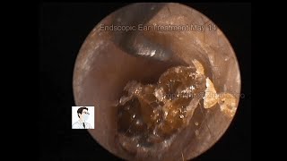 Special types of otitis media management20220514 youtube [upl. by Solon778]