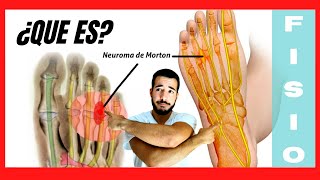 ¿Qué es el Neuroma de Morton y Qué lo Produce 🦶🏼 EVITALO [upl. by Yatnuhs]