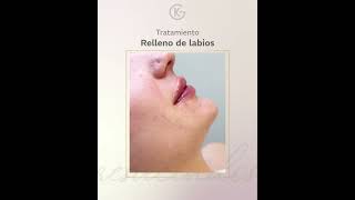 Relleno de Labios armonizacionfacial belleza clinicasesteticas clinicagulfo labiosperfectos [upl. by Thurmann830]